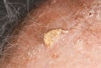 Image result for "cutaneous Horns". Size: 147 x 100. Source: www.sciencephoto.com