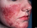 Image result for "athorybia Rosacea". Size: 132 x 100. Source: www.huidarts.com