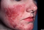 Image result for "athorybia Rosacea". Size: 144 x 100. Source: www.huidarts.com