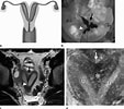 Image result for uterus bicornis bicollis. Size: 113 x 100. Source: www.researchgate.net
