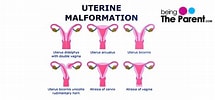Image result for Uterus Didelphys. Size: 215 x 100. Source: www.beingtheparent.com