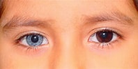 Image result for "heterochromia Rubra". Size: 198 x 100. Source: plano.co