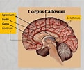 Bildergebnis für corpus callosum splenium. Größe: 121 x 100. Quelle: www.slideshare.net