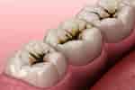Tooth Pulp cavity ಗಾಗಿ ಇಮೇಜ್ ಫಲಿತಾಂಶ. ಗಾತ್ರ: 150 x 100. ಮೂಲ: www.atlasdental.ca