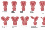 Bildergebnis für Uterus didelphys. Größe: 149 x 100. Quelle: www.thenursepage.com