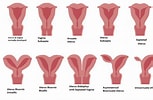 Image result for Uterus Didelphys. Size: 153 x 100. Source: www.thenursepage.com