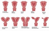 Image result for Uterus Didelphys. Size: 158 x 100. Source: www.thenursepage.com