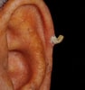 Image result for "cutaneous Horns". Size: 94 x 100. Source: emedicine.medscape.com