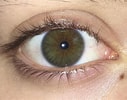 Image result for "heterochromia Rubra". Size: 127 x 100. Source: www.reddit.com