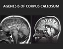 Image result for Corpus Callosum Mrt. Size: 128 x 100. Source: www.slideshare.net