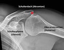Image result for Synovialsarkom Schultergelenk. Size: 127 x 100. Source: sportarzt.fit