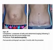تصویر کا نتیجہ برائے Before and After Tummy Tuck Surgery. سائز: 107 x 100۔ ماخذ: plastics.ufhealth.org