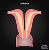 Image result for Uterus Didelphys. Size: 98 x 100. Source: radiopaedia.org