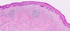 Afbeeldingsresultaten voor Lichen spinulosus Histology. Grootte: 227 x 100. Bron: www.animalia-life.club