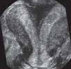 Image result for Uterus Didelphys. Size: 102 x 100. Source: www.researchgate.net