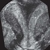 Bildergebnis für Uterus Didelphys. Größe: 99 x 100. Quelle: www.researchgate.net