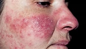 Image result for "athorybia Rosacea". Size: 176 x 100. Source: www.nrk.no