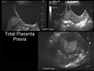 "spongosorites Placenta"-साठीचा प्रतिमा निकाल. आकार: 135 x 101. स्रोत: www.fetalultrasound.com