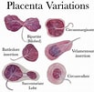 "spongosorites Placenta"-साठीचा प्रतिमा निकाल. आकार: 103 x 101. स्रोत: medizzy.com