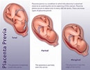 "spongosorites Placenta"-साठीचा प्रतिमा निकाल. आकार: 130 x 101. स्रोत: sigrid.knemeyer.com