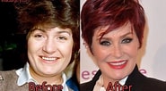 Image result for Sharon Osbourne Before Surgery. Size: 185 x 102. Source: viralsurgery.com