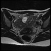 Bildergebnis für Uterus didelphys. Größe: 102 x 102. Quelle: radiopaedia.org
