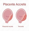"spongosorites Placenta"-साठीचा प्रतिमा निकाल. आकार: 96 x 103. स्रोत: stock.adobe.com