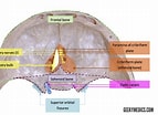 Bildergebnis für Foramen parietale Permagnum. Größe: 143 x 104. Quelle: geekymedics.com