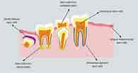 3rd Molar dental Pulp Cells ପାଇଁ ପ୍ରତିଛବି ଫଳାଫଳ. ଆକାର: 195 x 104। ଉତ୍ସ: www.wjgnet.com