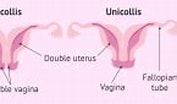 Image result for Uterus Didelphys. Size: 177 x 85. Source: www.invitra.com