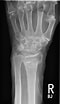 Schaftfraktur im Unterarm に対する画像結果.サイズ: 60 x 104。ソース: www.doccheck.com
