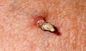 Image result for "cutaneous Horns". Size: 175 x 105. Source: www.sciencephoto.com