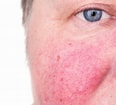 Image result for "athorybia Rosacea". Size: 116 x 105. Source: www.singerskin.com
