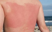 Image result for Photosensitivity to the Sun. Size: 169 x 105. Source: suttonderm.com