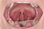 Biletresultat for normal Tonsil Strep Throat. Storleik: 157 x 105. Kjelde: www.sciencephoto.com
