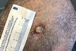 Image result for "cutaneous Horns". Size: 157 x 105. Source: www.dermatologyadvisor.com