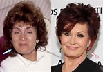 Image result for Sharon Osbourne Before Surgery. Size: 149 x 105. Source: www.plasticsurgerypeople.com