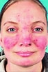 Image result for "athorybia Rosacea". Size: 70 x 105. Source: healthjade.net