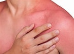 Image result for Photosensitivity to the Sun. Size: 144 x 105. Source: news.cancerconnect.com