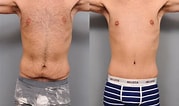 تصویر کا نتیجہ برائے Before and After Tummy Tuck Surgery. سائز: 179 x 106۔ ماخذ: www.drsterry.com