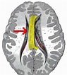 Image result for Corpus Callosum Beschriftung. Size: 95 x 106. Source: ar.inspiredpencil.com