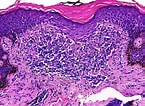 Afbeeldingsresultaten voor Lichen spinulosus Histology. Grootte: 145 x 106. Bron: www.pathologyoutlines.com