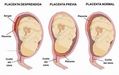 "spongosorites Placenta"-साठीचा प्रतिमा निकाल. आकार: 168 x 106. स्रोत: www.proyecto-bebe.es