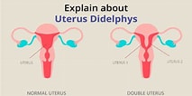 Bildergebnis für Uterus Didelphys. Größe: 213 x 106. Quelle: birlafertility.com