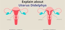 Image result for Uterus Didelphys. Size: 226 x 106. Source: proper-cooking.info