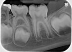 3rd Molar dental pulp Cells के लिए छवि परिणाम. आकार: 146 x 106. स्रोत: teethbondingg.blogspot.com