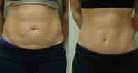 Before and After Tummy Tuck Surgery ପାଇଁ ପ୍ରତିଛବି ଫଳାଫଳ. ଆକାର: 200 x 106। ଉତ୍ସ: cosmeticsurgerytips.com