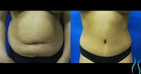 تصویر کا نتیجہ برائے Before and After Tummy Tuck Surgery. سائز: 202 x 106۔ ماخذ: www.youtube.com