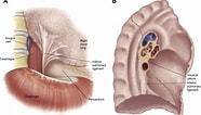 Image result for posttraumatische Pneumatocele Im Ligamentum Pulmonale Inferior. Size: 186 x 106. Source: www.semanticscholar.org