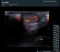 Billedresultat for Hodentorsion Sonographie. størrelse: 123 x 106. Kilde: www.urologie-wienerplatz.de